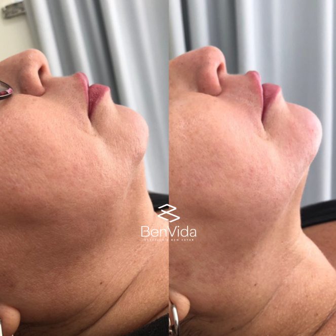 Resultado real de harmonização facial na Benvida