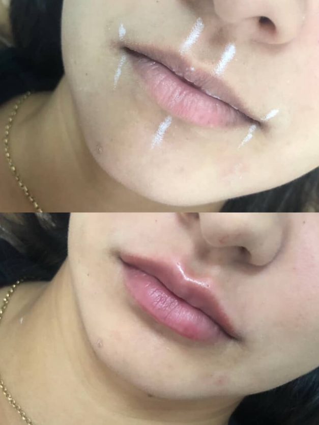 Resultado real de preenchimento labial na Benvida