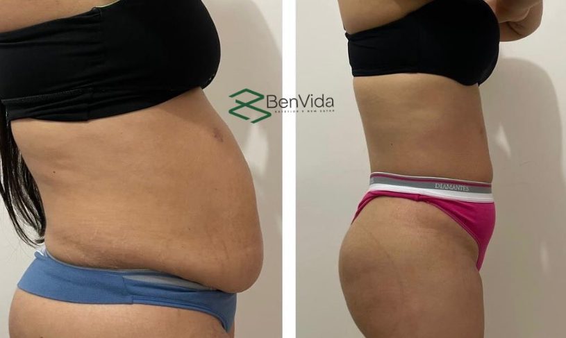 Resultado real de massagem modeladora na Benvida